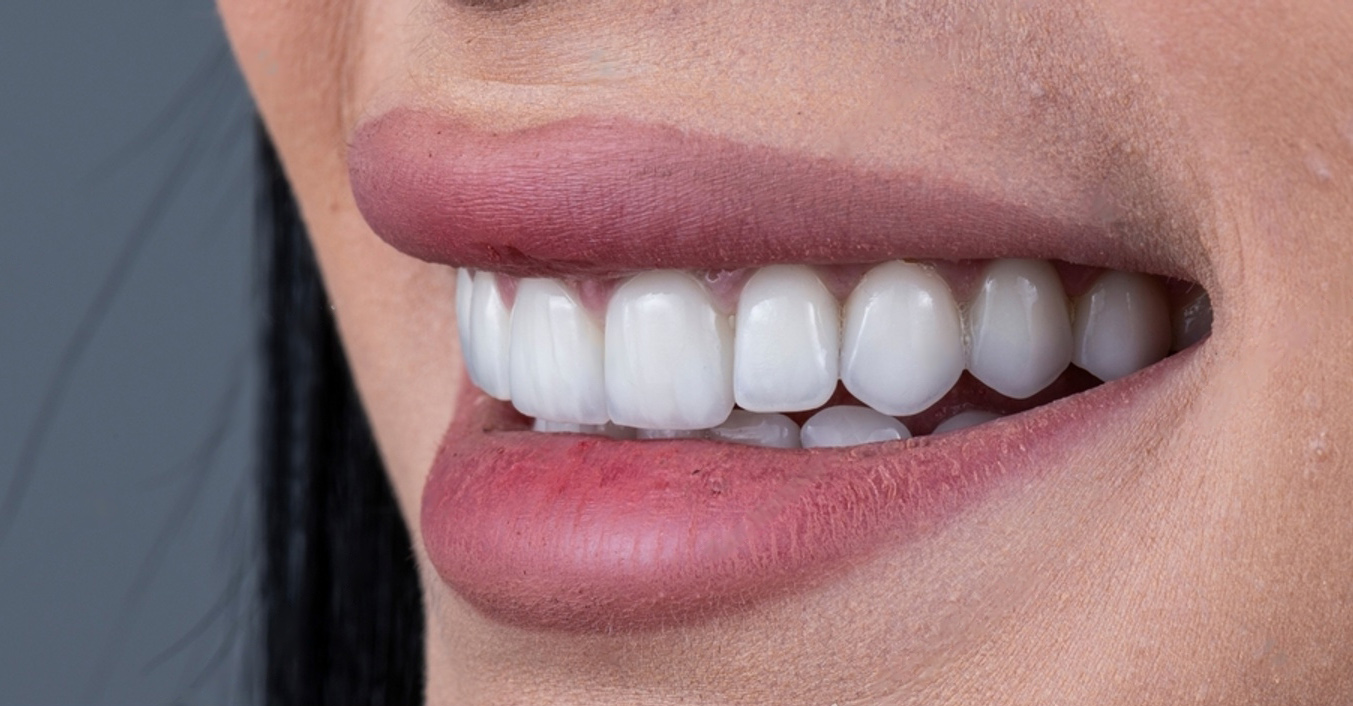 veneers Welland